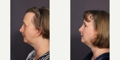 Brow Lift before and after photo