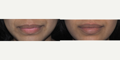 Dermal Fillers before and after photo