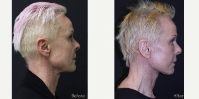 Eyelid Surgery before and after photo