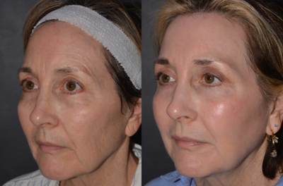 Phenol Peel before and after photo