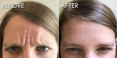 Botox before and after photo