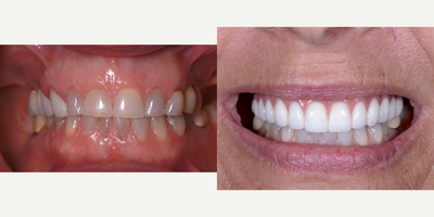 Dental Implants before and after photo