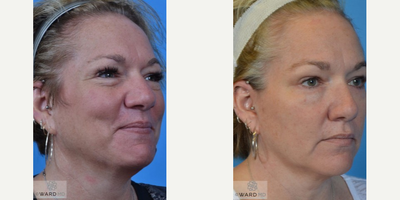 Eyelid Surgery before and after photo