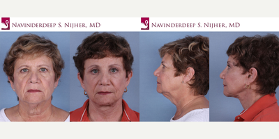 Facelift before and after photo