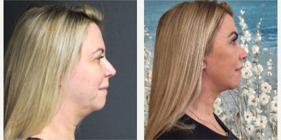 Facelift before and after photo