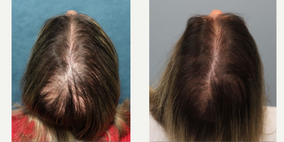 Hair Loss Treatment before and after photo