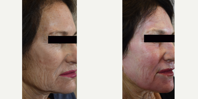 Laser Resurfacing before and after photo