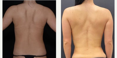 Liposuction before and after photo