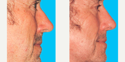 Rhinoplasty before and after photo
