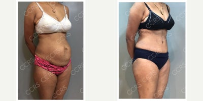 Tummy Tuck before and after photo