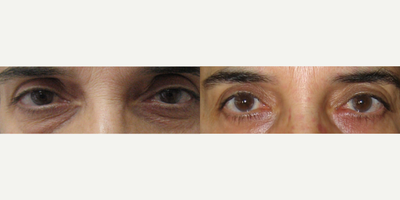 CO2 Laser before and after photo