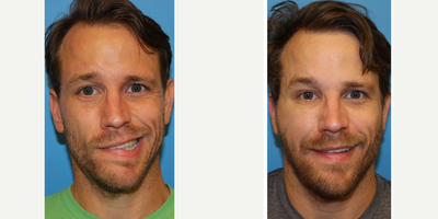 Facial Reconstructive Surgery before and after photo