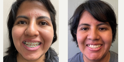Genioplasty before and after photo