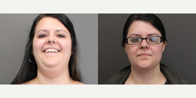 Liposuction before and after photo
