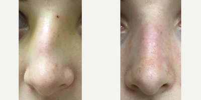 Rhinoplasty before and after photo