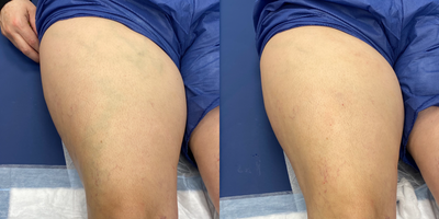 Sclerotherapy before and after photo