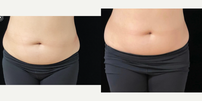 truSculpt before and after photo