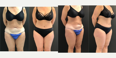 Tummy Tuck before and after photo