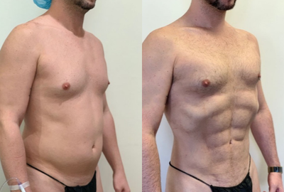 Abdominal Etching before and after photo