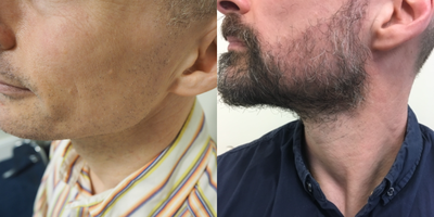 Beard Transplant before and after photo