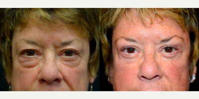 Eyelid Surgery before and after photo