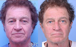 Eyelid Surgery before and after photo