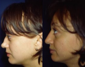 Nonsurgical Nose Job before and after photo
