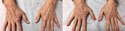 Radiesse before and after photo