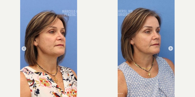 Revision Rhinoplasty before and after photo