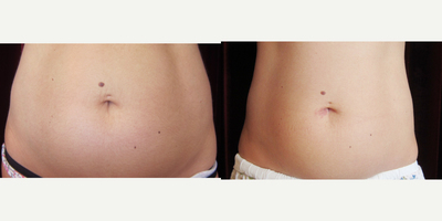 CoolSculpting before and after photo