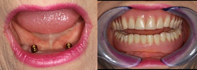 Dental Implants before and after photo