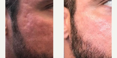 Laser Resurfacing before and after photo