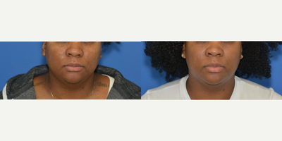 Microneedling before and after photo