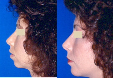 Chin Implant before and after photo