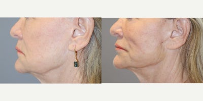 before and after image