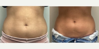 Ultrasonic Cavitation before and after photo