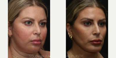 Chin Implant before and after photo