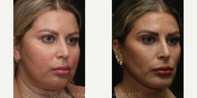 Chin Implant before and after photo