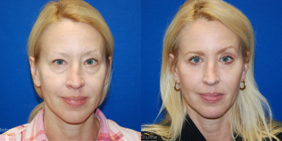 Eyelid Surgery before and after photo