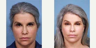 Eyelid Surgery before and after photo