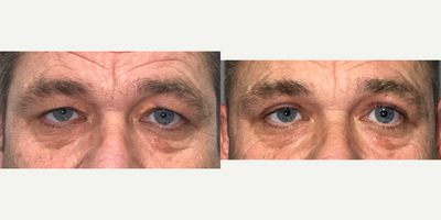 Eyelid Surgery before and after photo