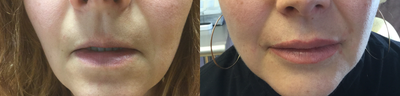 Juvederm before and after photo