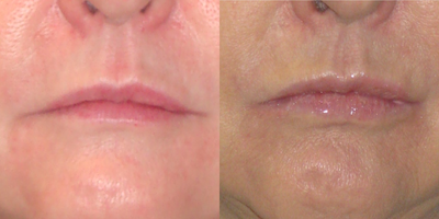 Lip Fillers before and after photo