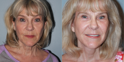 Lower Facelift before and after photo