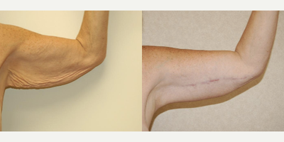 Arm Lift before and after photo