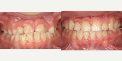 Braces before and after photo