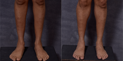 Calf Implant before and after photo