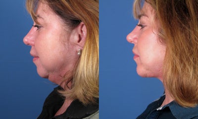 Chin Implant before and after photo