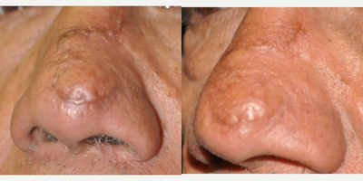 CO2 Laser before and after photo
