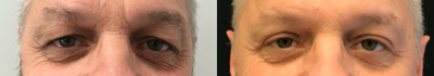 Eyelid Surgery before and after photo